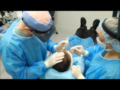 how to sleep after fue hair transplant