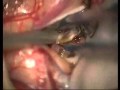 Aneurysm: Inappropriate Yasargil Clips Application - Patient 1 Aneurysm: Inappropriate Yasargil Clips Application - Patient 1