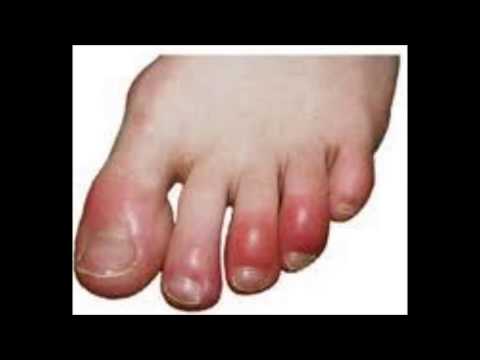 how to cure chilblains