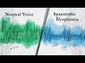 Spasmodic Dysphonia: A Peculiar Voice Disorder