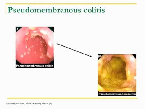 how to treat c diff in pregnancy