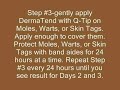 Mole Removal Video  Warts Zinc