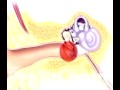preop® Patient Education Myringotomy Insertion of Tube 4
