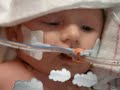 CDH awareness In loving memory of Drake Michel