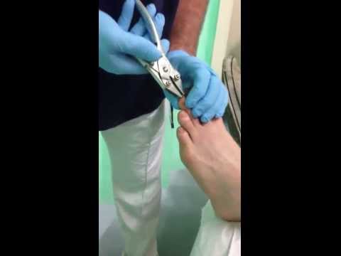 how to remove k wires