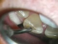Anterior Class IV composite removal with VersaWave Laser Anterior Class IV composite removal with VersaWave Laser
