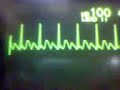ECG Video: Atrial Flutter