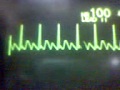 ECG Video: Atrial Flutter
