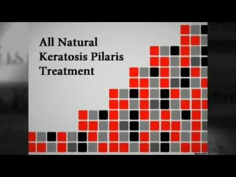how to cure keratosis pilaris fast