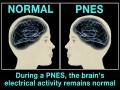PNES's: Psychogenic Non-Epileptic Seizures (Health Guru)