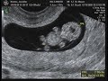 9 weeks 2 days 4D Ultrasound