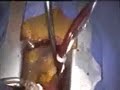 Minimally Invasive Aortic Valve Replacement