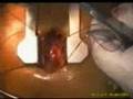 Minimally Invasive Aortic Valve Replacement