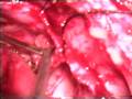 Intervention For Nose Cerebrospinal Fluid Leakage