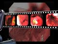 Gastric Ulcer Presentation