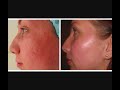 Laser is very effective in the treatment of Skin Diseases as well as aesthetic procedures. Dr.Hanish Babu, MD, Dermatologist and Cosmetologist presents a short Video on the Laser Applications