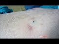 Sebaceous Cyst Left Arm