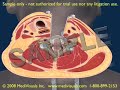 3D/2D Medical Animation: Anterior Cervical Fusion 3D/2D Medical Animation: Anterior Cervical Fusion