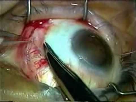 how to cure ischemia