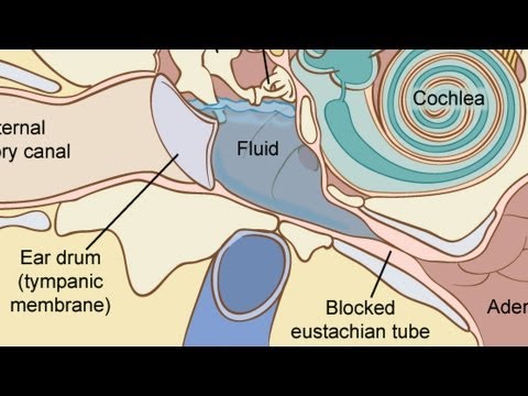 Fluid Behind Middle Ear Adults Fluid Behind Middle Ear Adults