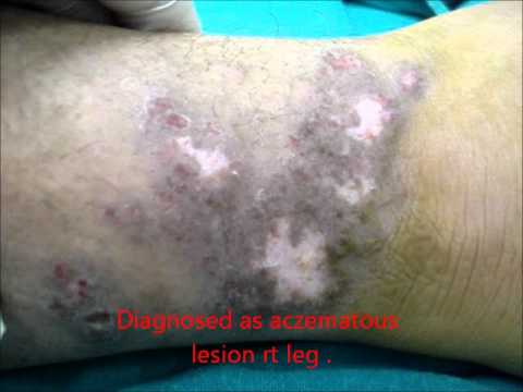 how to manage eczema