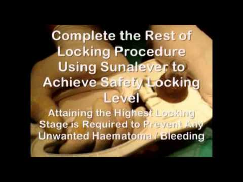 Adult Disposable Circumcision Device part 2