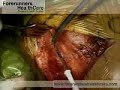 Shoulder surgery in India for shoulder arthritis.  Osteoarthritis Rheumatoid Arthritis