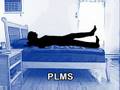 restless leg syndrome