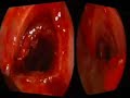 Endoscopic diilation of tracheal stenosis