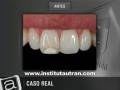 Estética dental: dientes manchados (problema y solución)