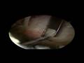 Gluteus medius tears- Hip Arthroscopy