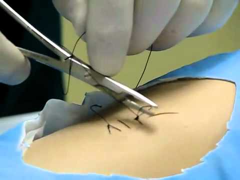 how to remove sutures