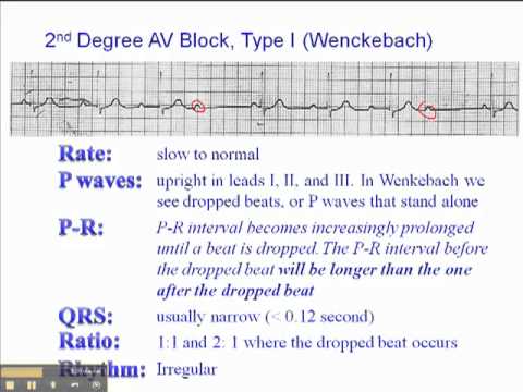 how to treat 2nd degree heart block