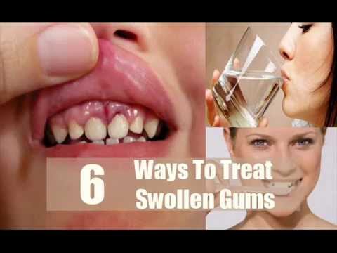 how to relieve swollen gums