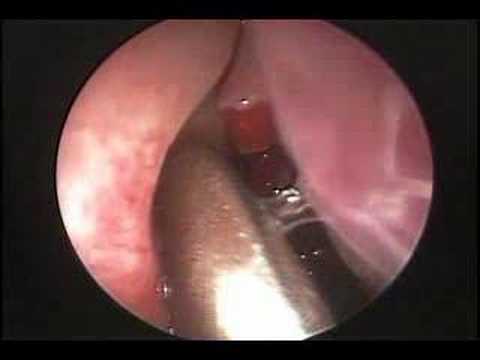 how to unclog ethmoid sinus