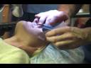 Lasik Surgery Pt 2 - Surgery Lasik Surgery Pt 2 - Surgery