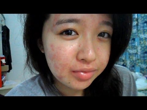 My Acne Story: 15th Week of Accutane