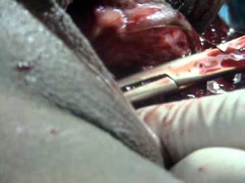 how to relieve episiotomy pain