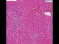 Histopathology Liver--Acute myeloid leukemia