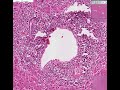 Histopathology Liver--Acute myeloid leukemia Histopathology Liver--Acute myeloid leukemia