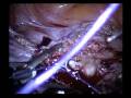 Laparoscopic Suturing of Bleeding Vessel