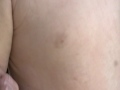 allergic rash