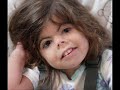 Sindrome de Brachmann de Lange (Cornelia de Lange)