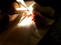 cyst being removed