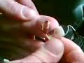 Balls out pulls his own toe nail off! aaaaaaaaaarrrrrrrrrrrrrhhhhhhhhhhhh