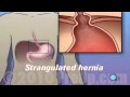PreOp® Patient Education Hernia - Hiatal Open Repair