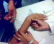 videos de quitando tornillos fijador de muñeca. wrist fixator