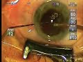 Cataract Phaco-Ozil Cataract Phaco-Ozil