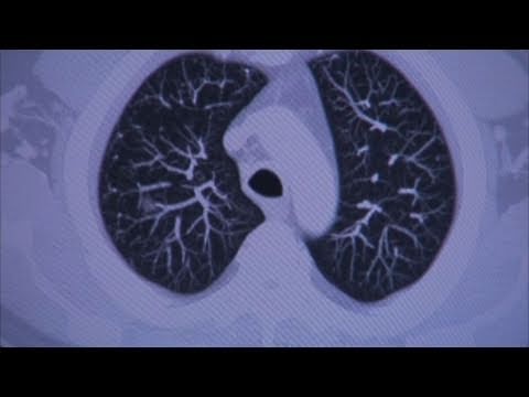 The Benefits of CT Screening for Lung Cancer