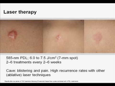 Hypertrophic scarring and keloids: Part 2 of 2